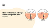 How to Remove a Deep, Painful Ingrown Hair (Safely)