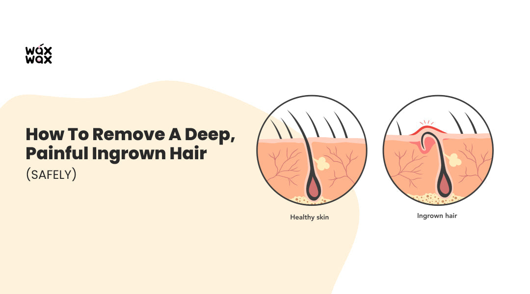 How to Remove a Deep, Painful Ingrown Hair (Safely)