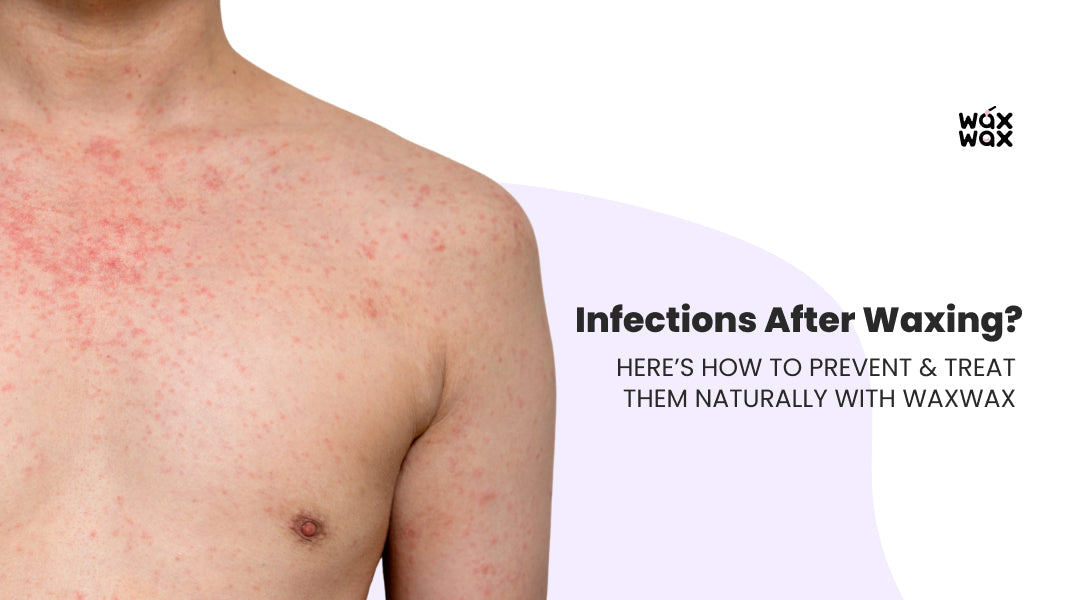 Infections After Waxing? Here’s How to Prevent & Treat Them Naturally with WaxWax